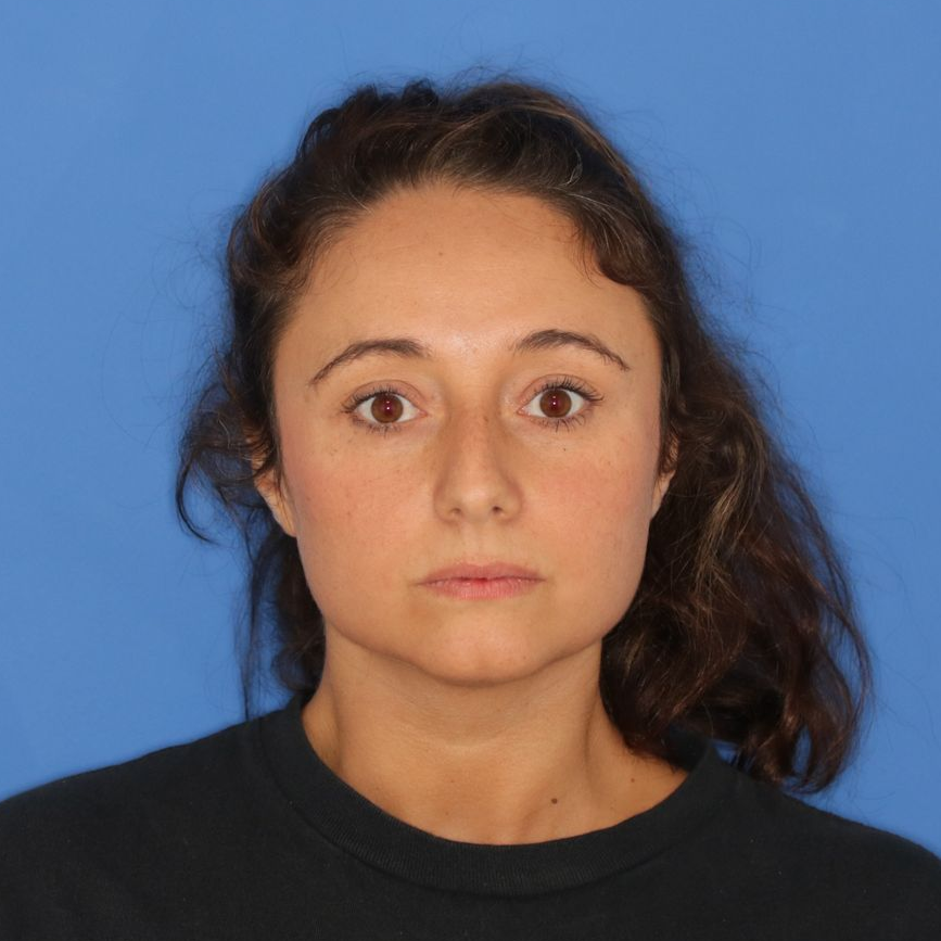 36 year old female before undergoing cosmetic rhinoplasty posing on a blue background