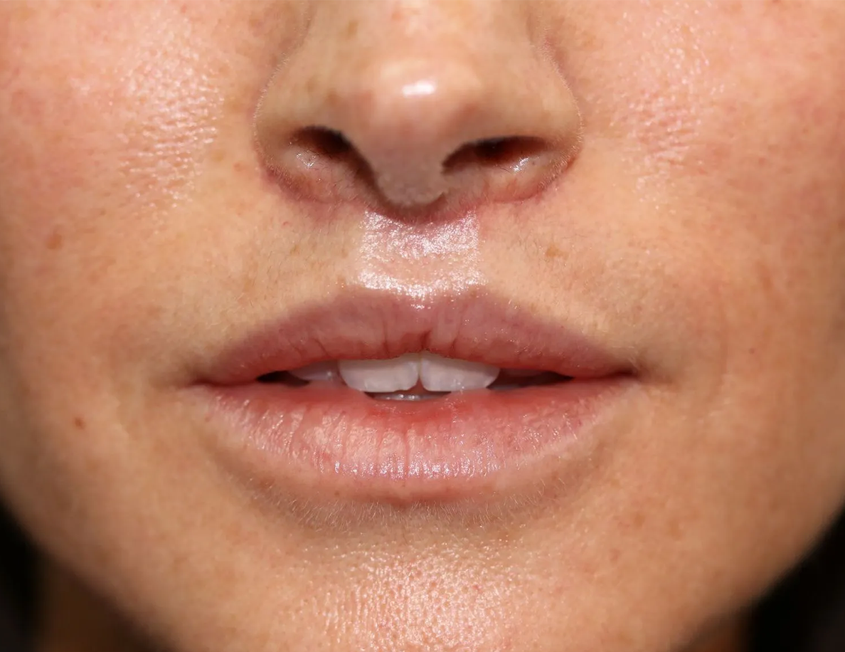 Close up of a woman after Lip Lift surgery at Carson Williams Facial Plastic Surgery in Leawood, KS