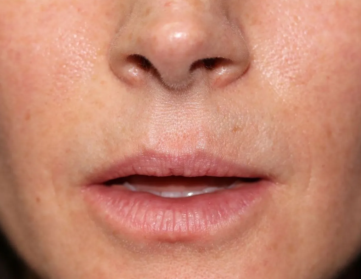 Close up of a woman before Lip Lift surgery at Carson Williams Facial Plastic Surgery in Leawood, KS