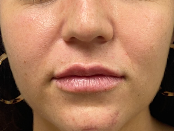 An after picture for lip filler treatment at Carson Williams MD Facial Plastic Surgery
