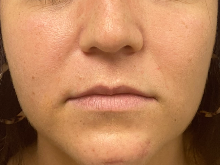 A before picture for lip filler treatment at Carson Williams MD Facial Plastic Surgery