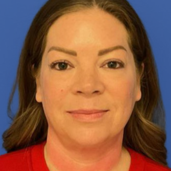 43 year old female underwent a lip lift posing for a before photo