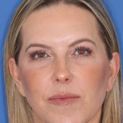 Close up of a woman before eyelid surgery at Carson Williams Facial Plastic Surgery in Leawood, KS