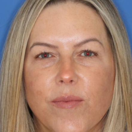 Close up of a woman before eyelid surgery at Carson Williams Facial Plastic Surgery in Leawood, KS