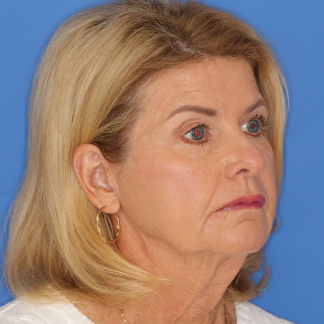 Close up of a woman before Facelift surgery at Carson Williams Facial Plastic Surgery in Leawood, KS