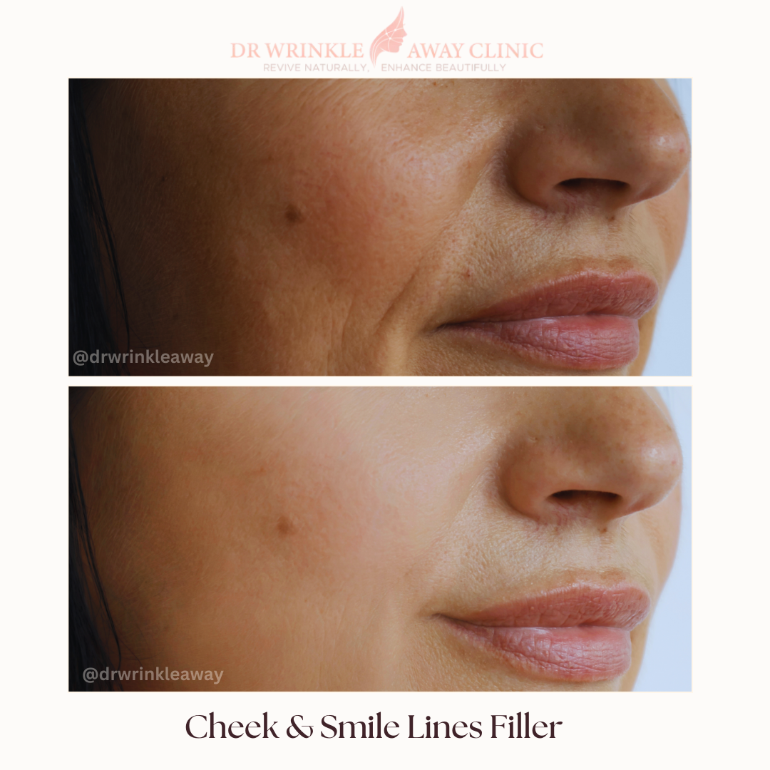 A before and after photo of a woman 's face with check and smile lines filler.