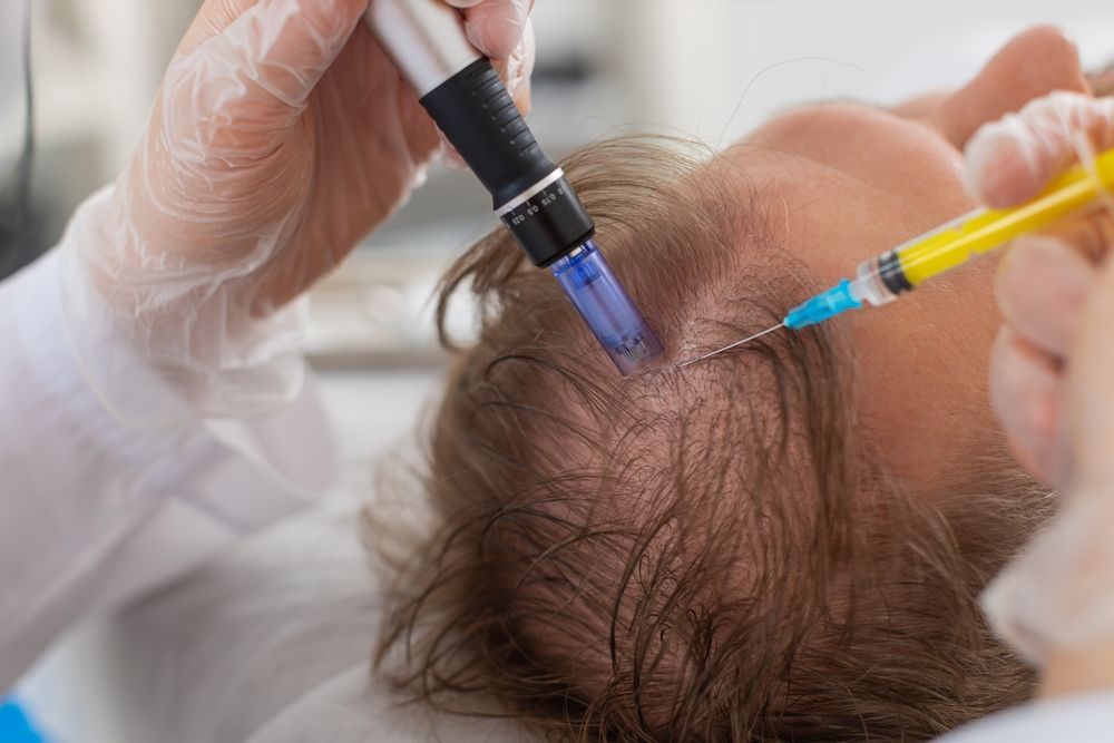 Person receiving scalp treatment: microneedling and injection in hair-thinning area; gloved hands, close-up.