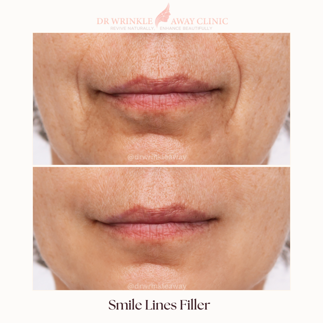 A before and after photo of a woman 's lips with smile lines filler.