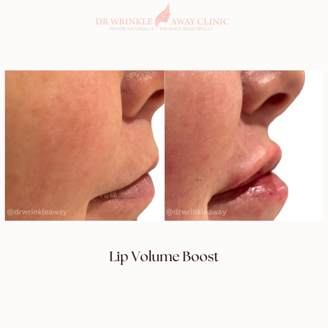 A before and after photo of a woman 's lip volume boost