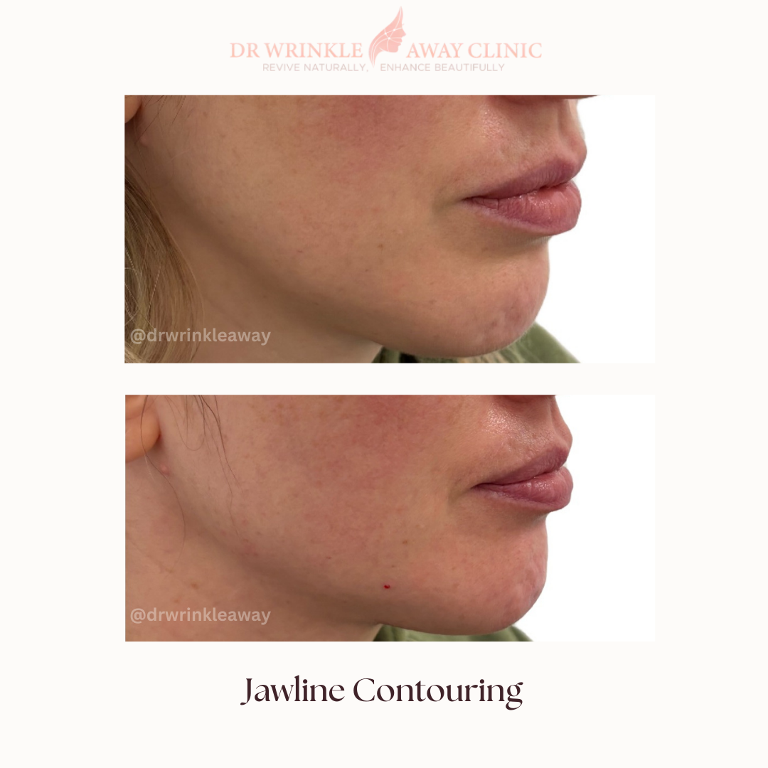 A woman 's face is shown before and after jawline contouring