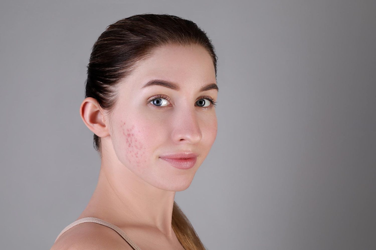 A woman with acne on her face is looking at the camera.