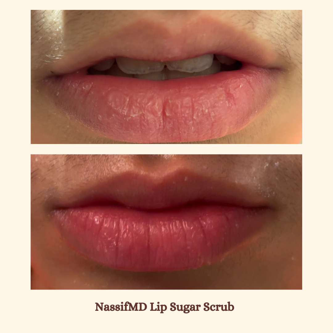 A before and after photo of a person 's lips.
