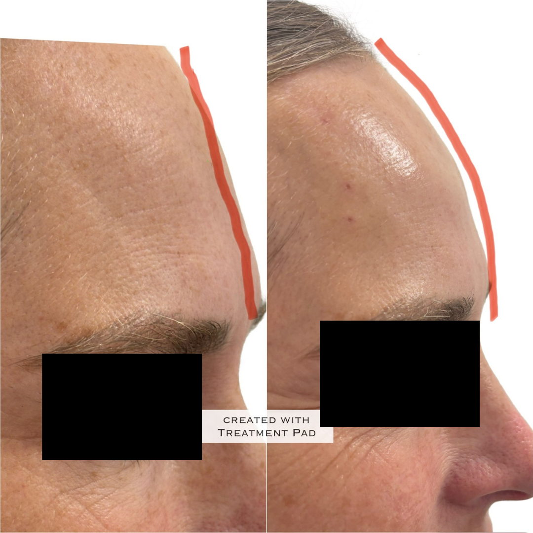 A before and after photo of a woman 's forehead