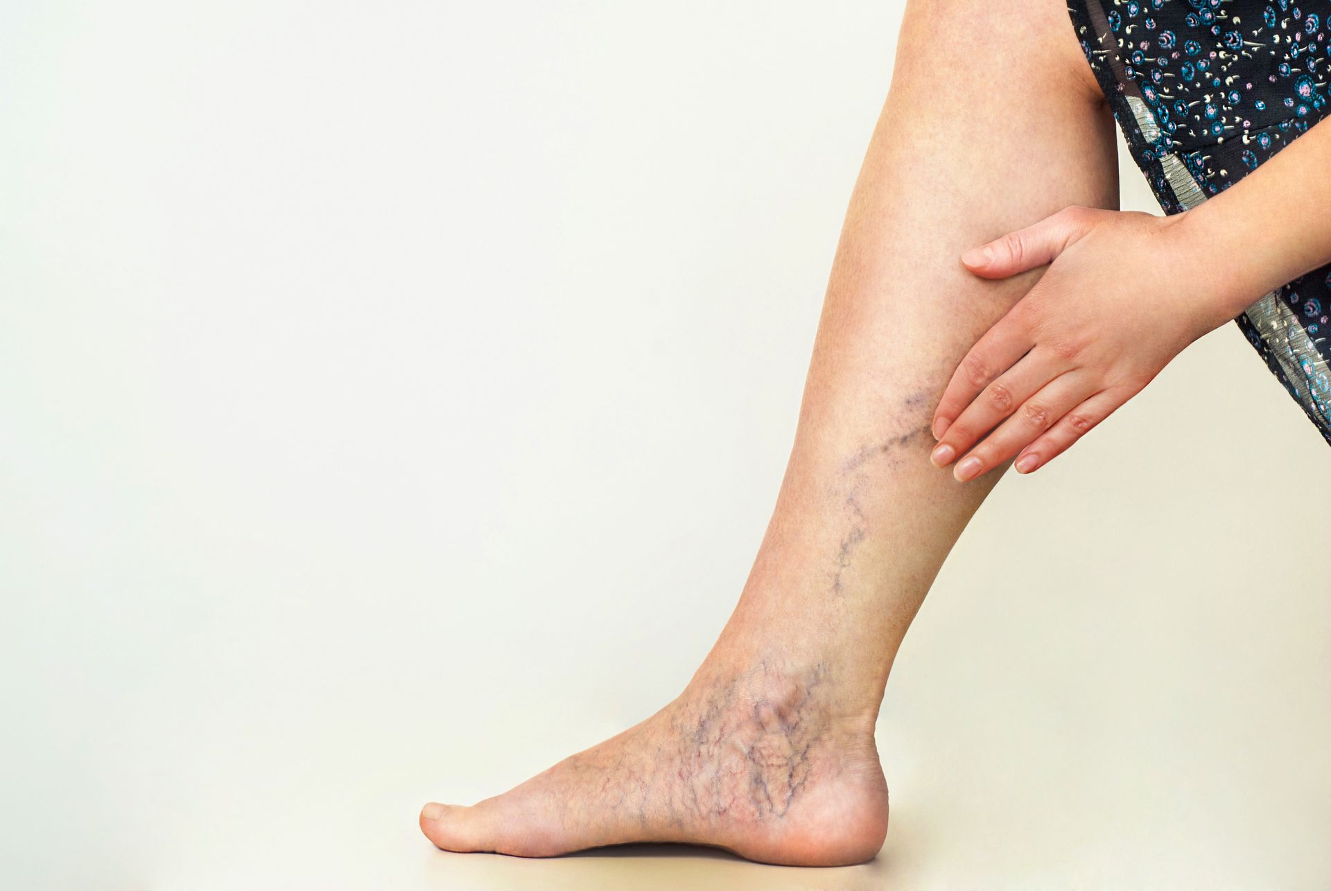 Leg with visible varicose veins, person touching the area.