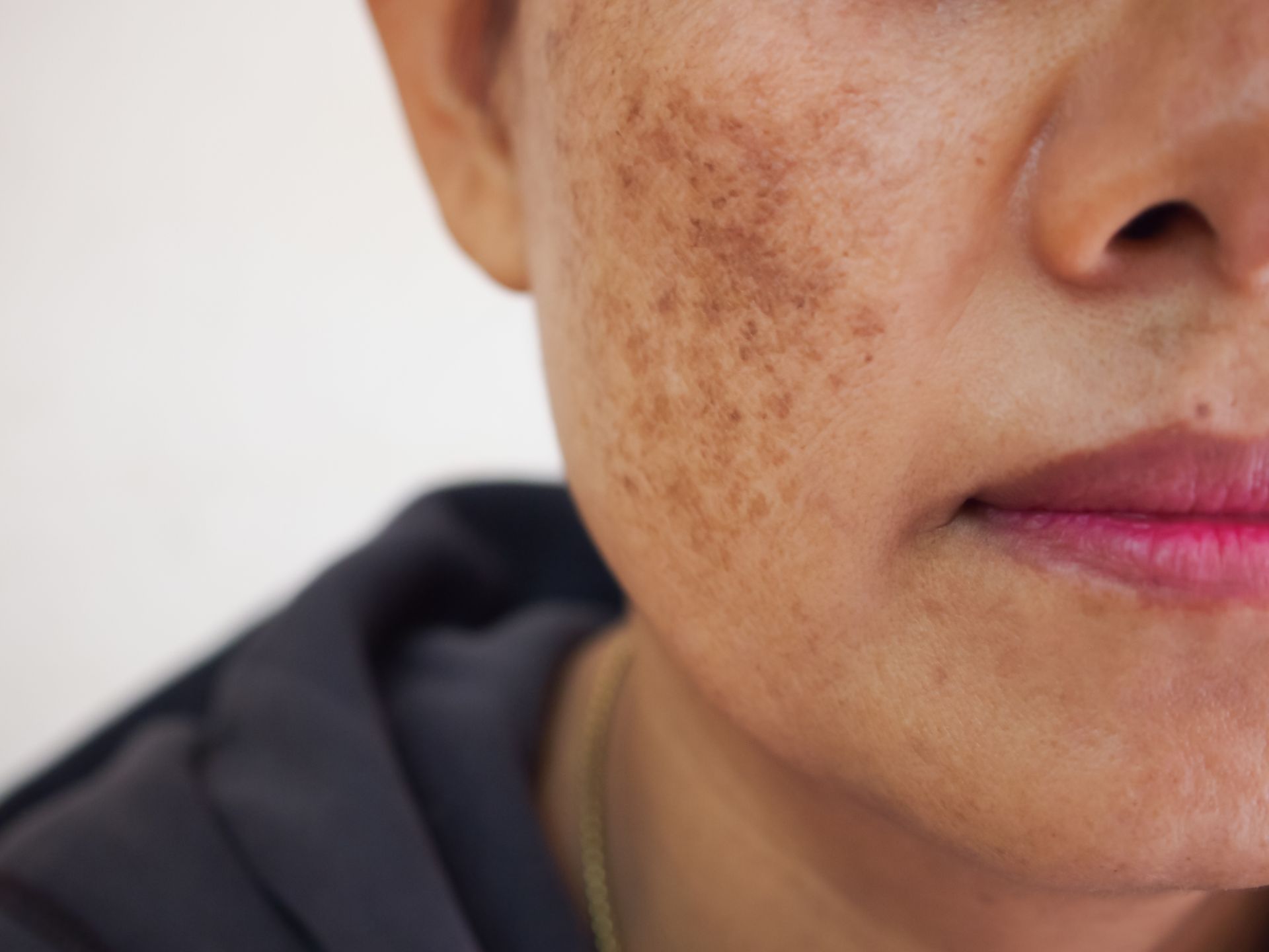 Woman with brown patches of hyperpigmentation on her cheek and face.