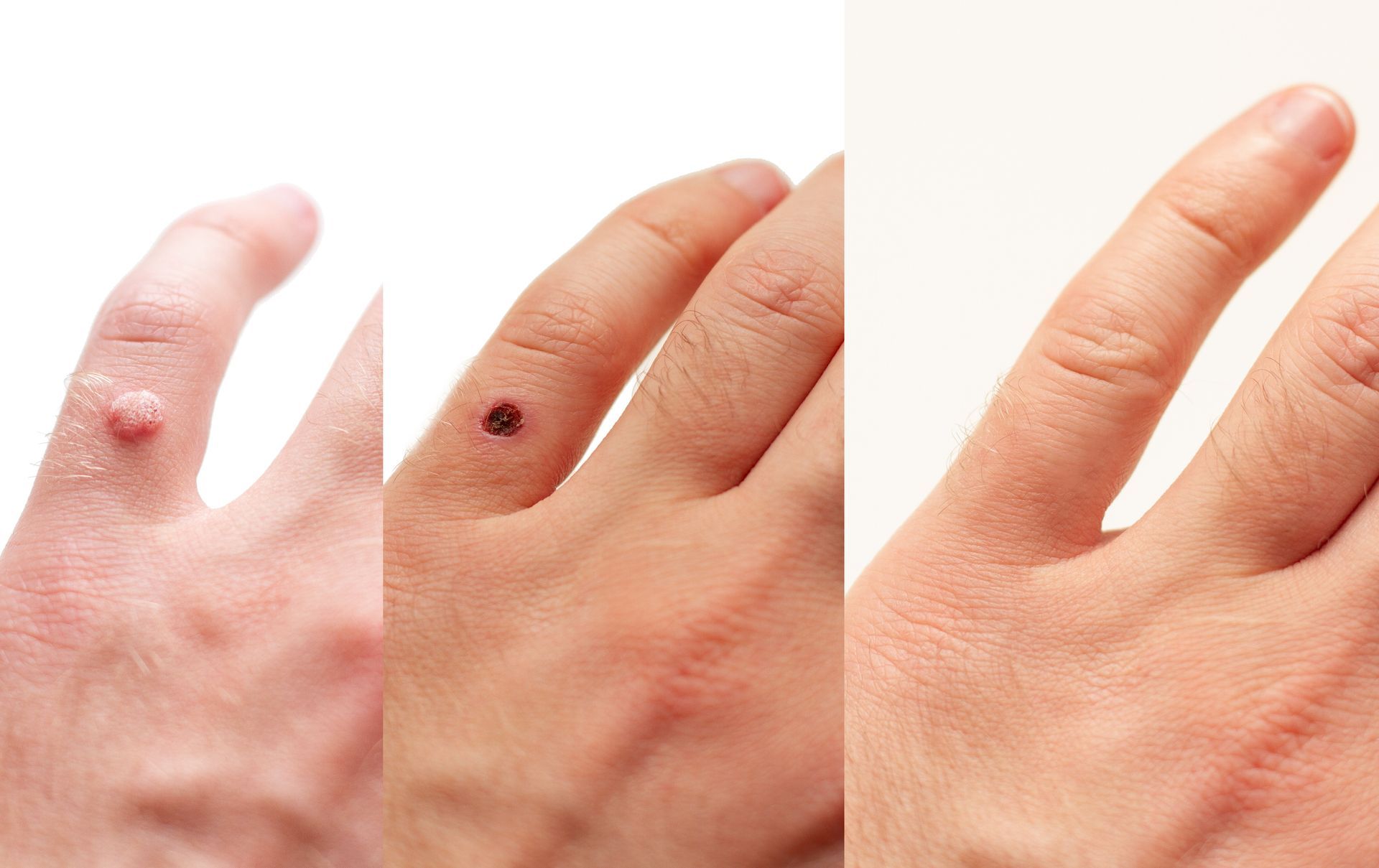 A series of three photos showing the progression of a wart on a finger from before, during, and after treatment.