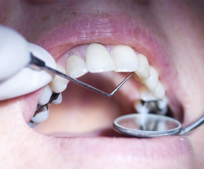 Patient having a dental examination up, close up with narrow depth of field focus on probe