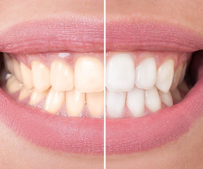Perfect smile before and after bleaching.
