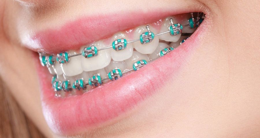 A close up of a woman 's teeth with blue braces.