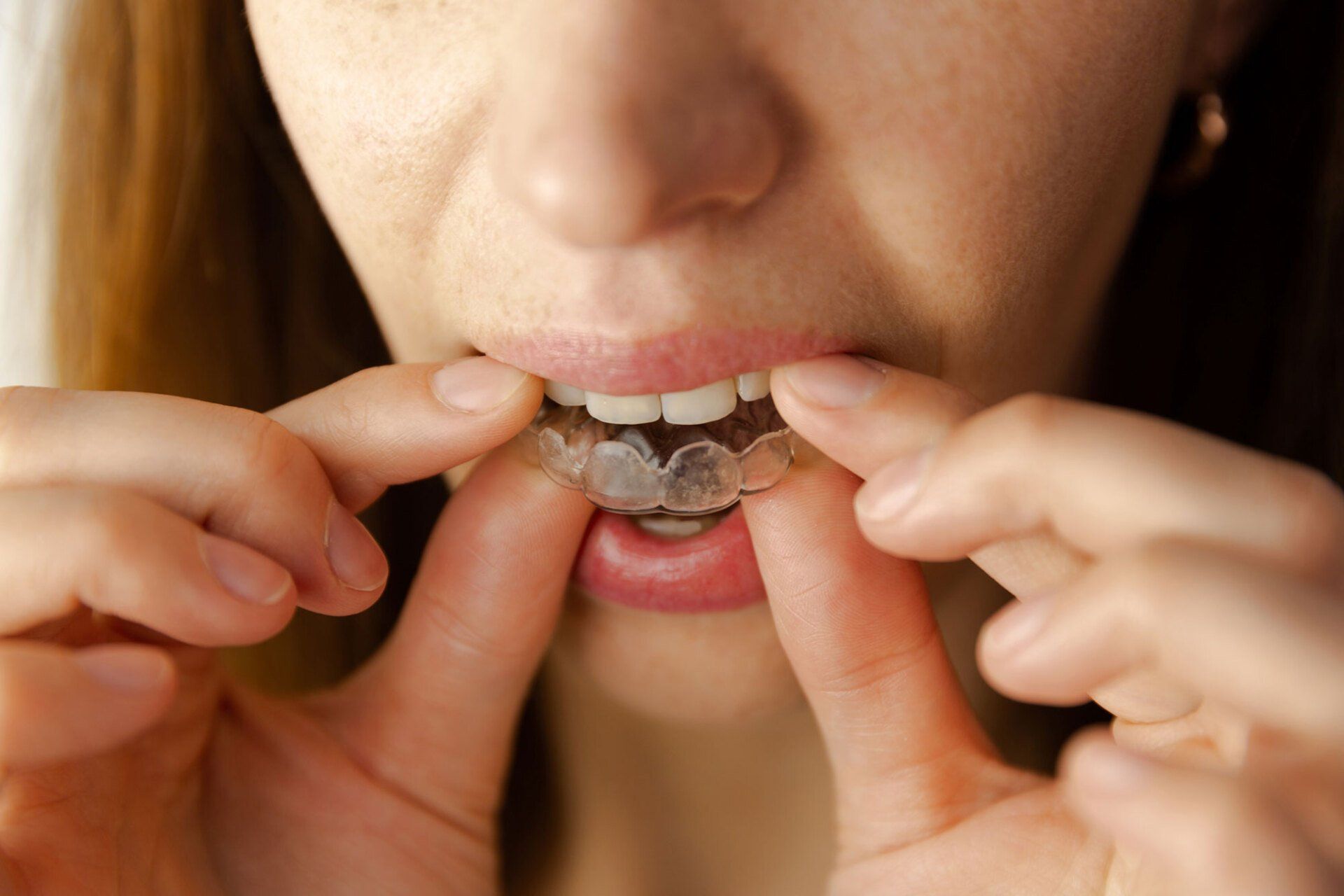 Woman Puts Transparent Night Guard — Sylacauga, AL — O'Brien Family Dentistry
