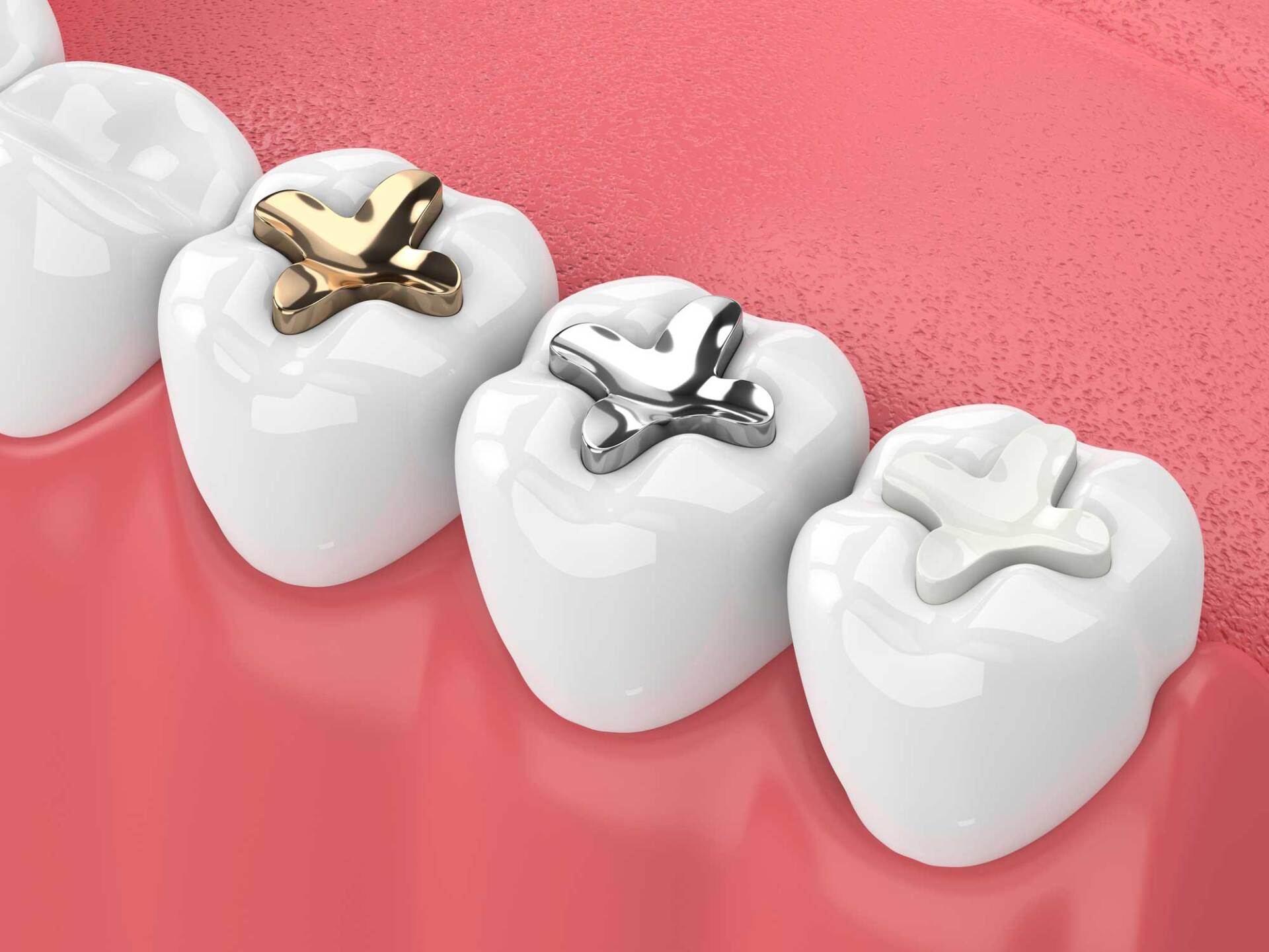 Teeth with Inlay — Sylacauga, AL — O'Brien Family Dentistry