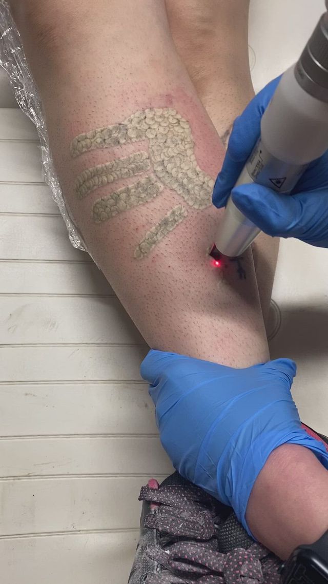 Tattoo removal - Undo | Hét expertisecentrum en de #1 Laserkliniek in  Nederland