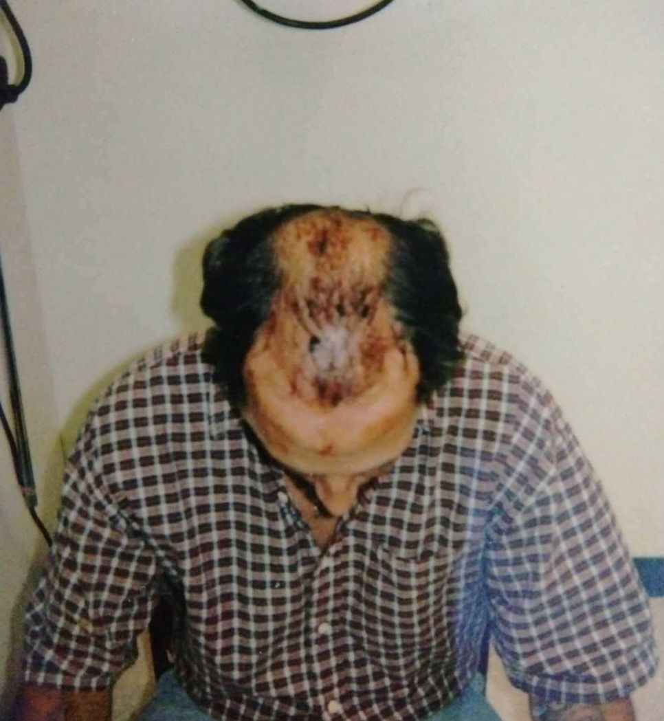 Hair transplant procedure in progress