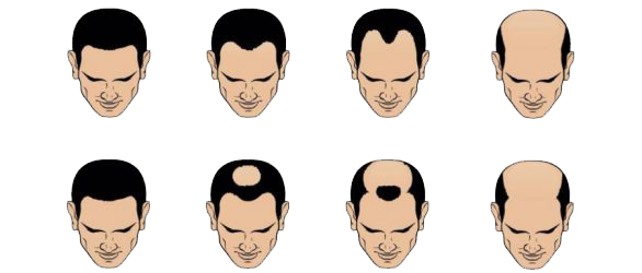 a cartoon of a man 's head with different types of hair loss