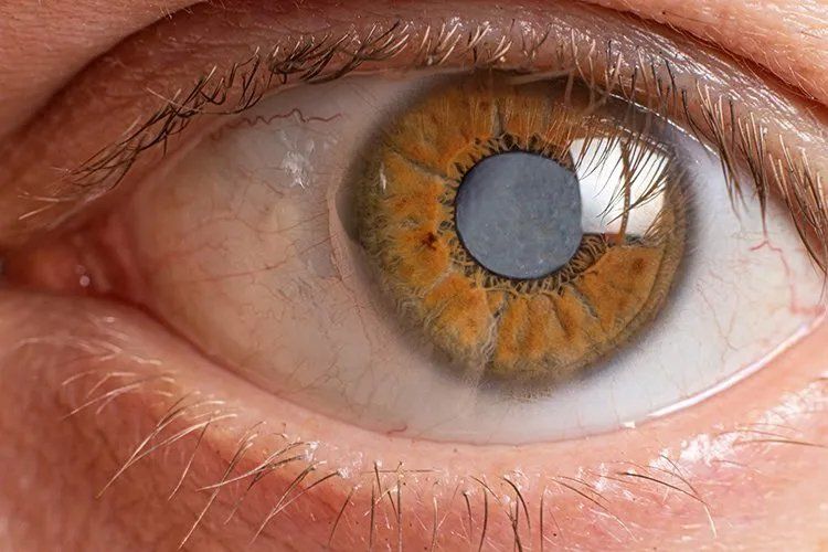 Cataract & Lens-Based Surgery