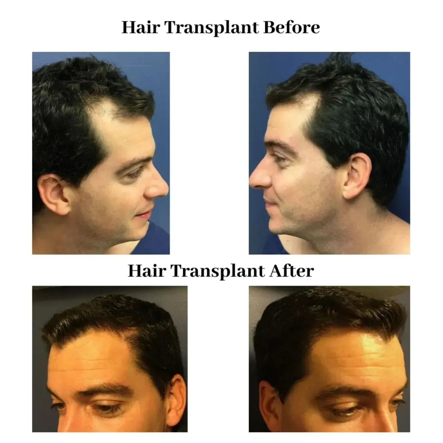 Hair transplant before and after