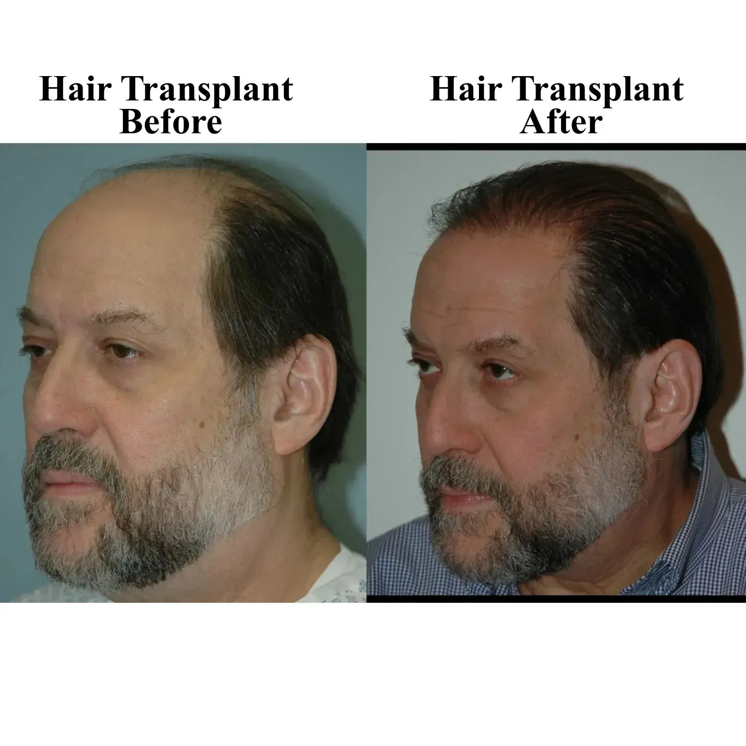 Hair transplant before and after