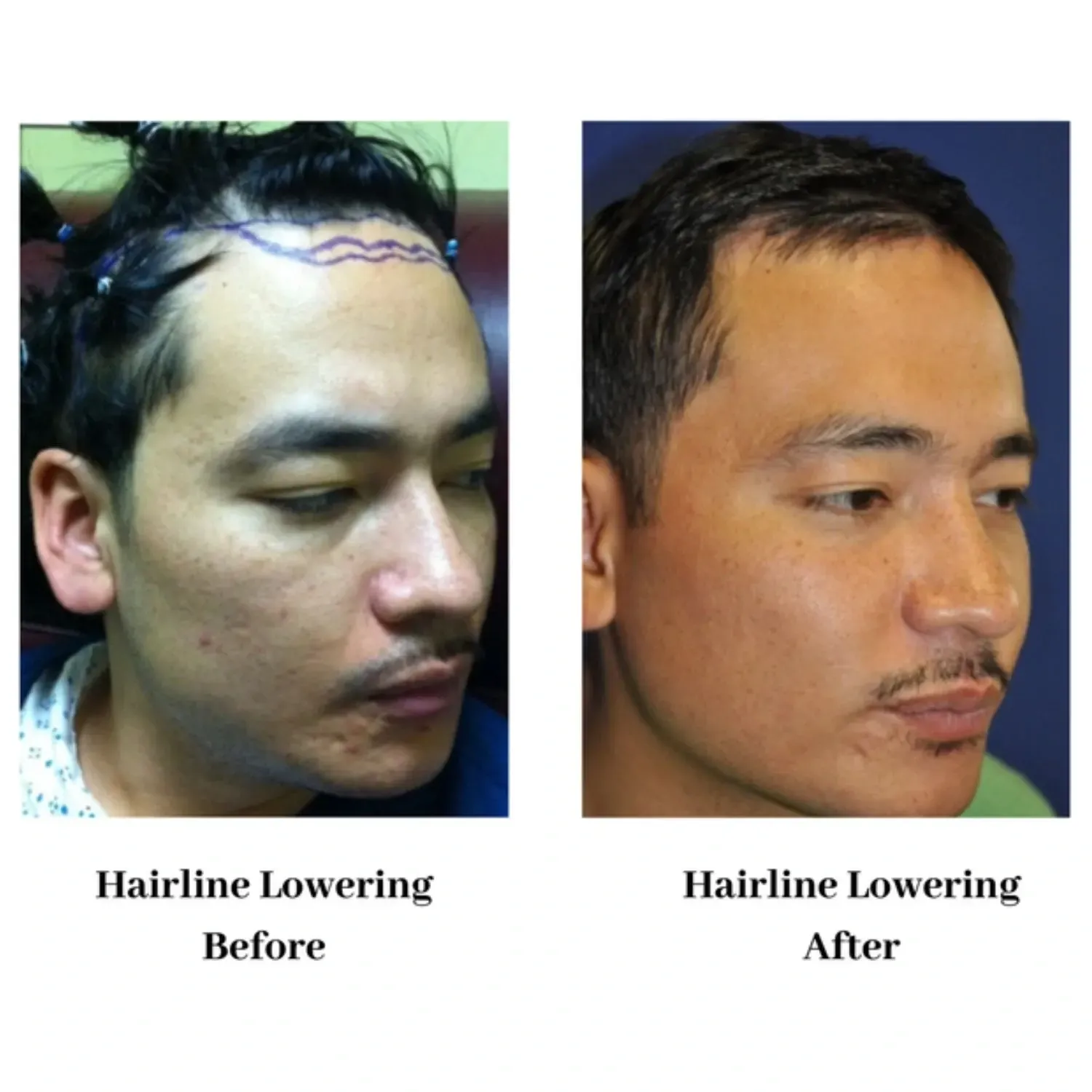 Hair transplant before and after