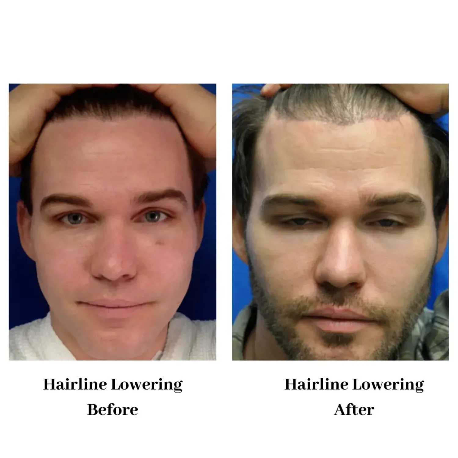 Hair transplant before and after