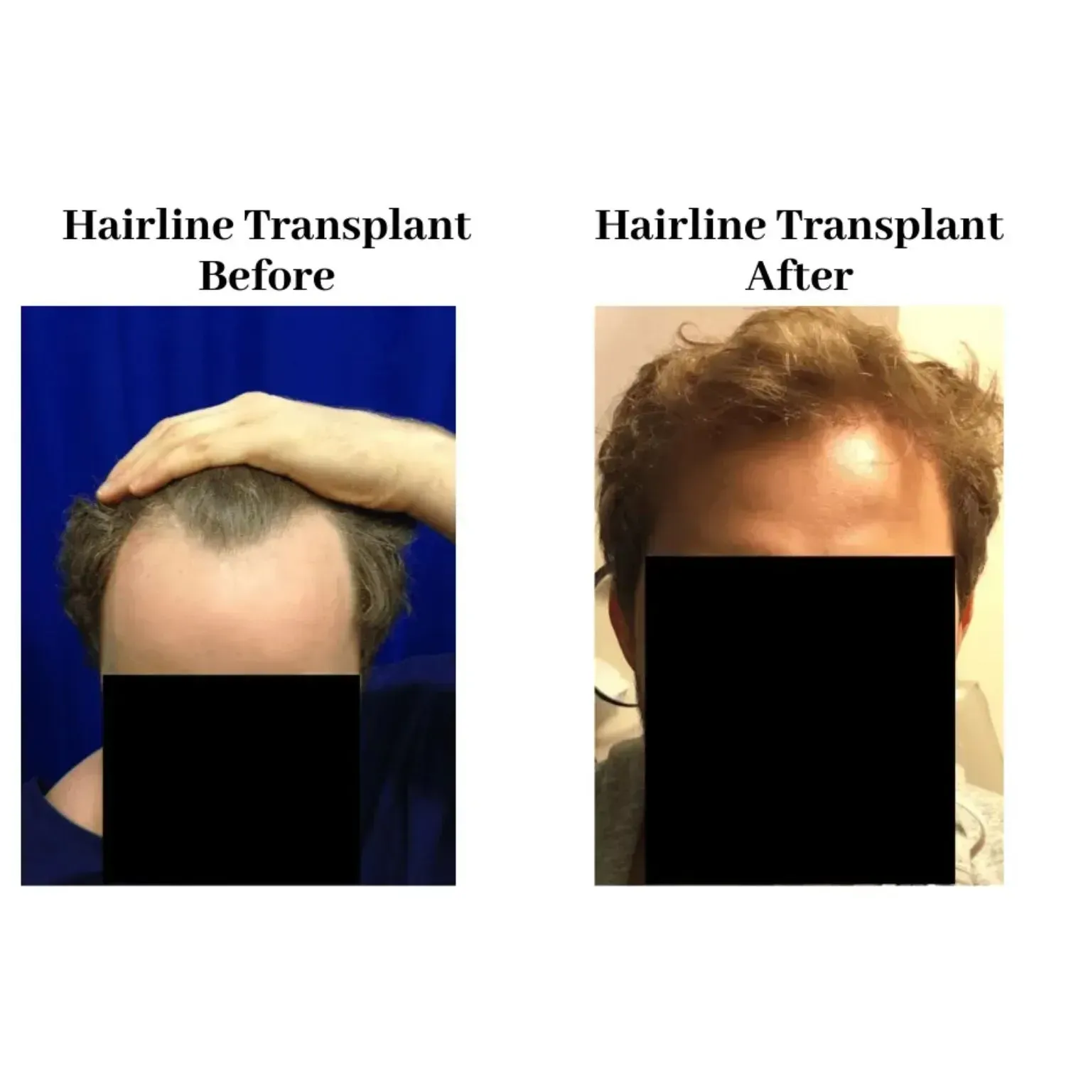 Hair transplant before and after