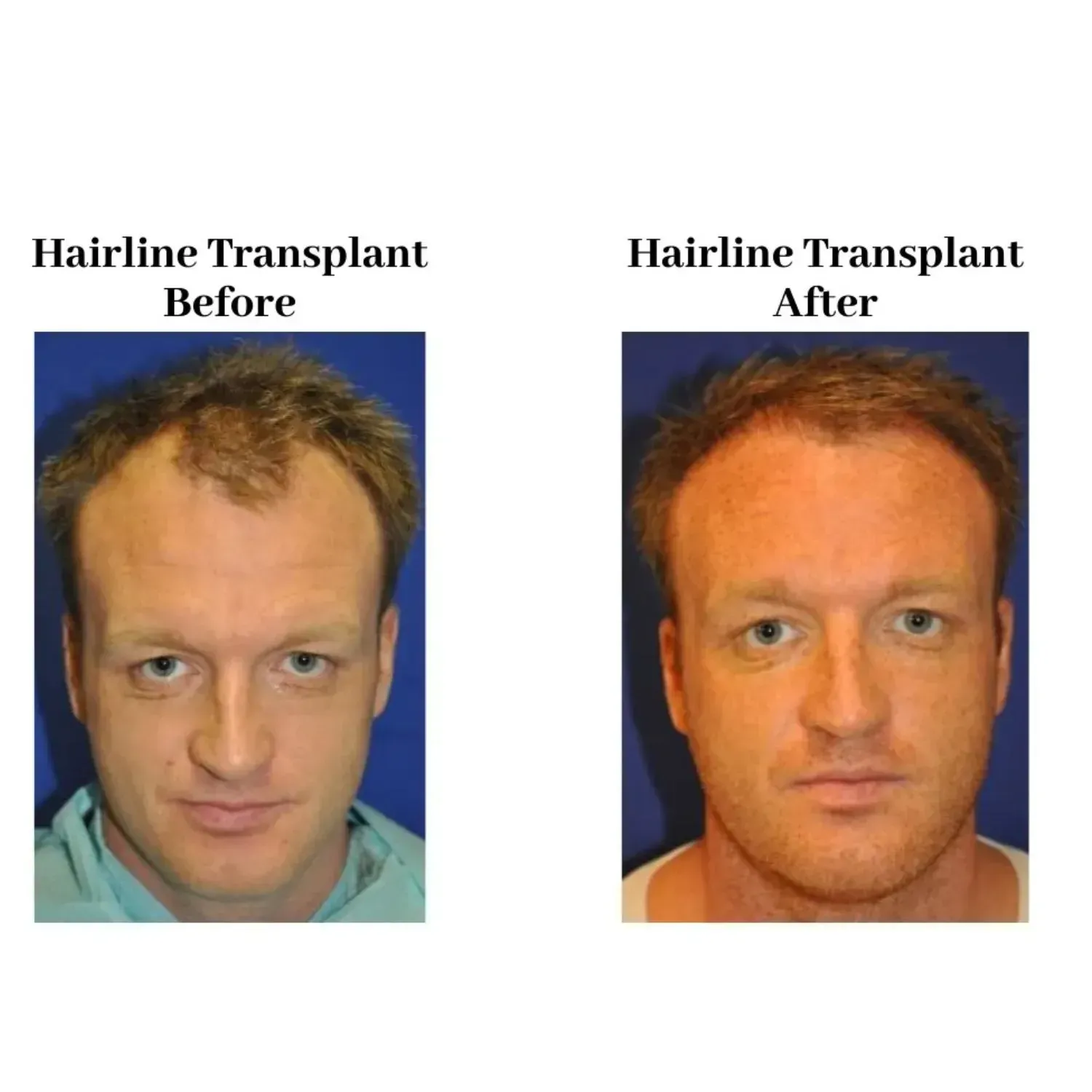 Hair transplant before and after
