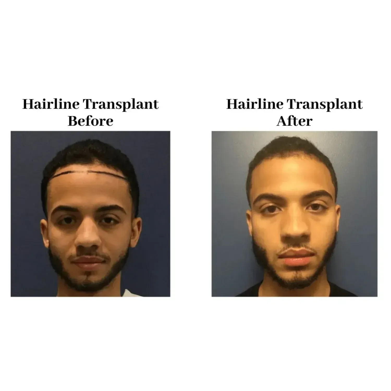 Hair transplant before and after