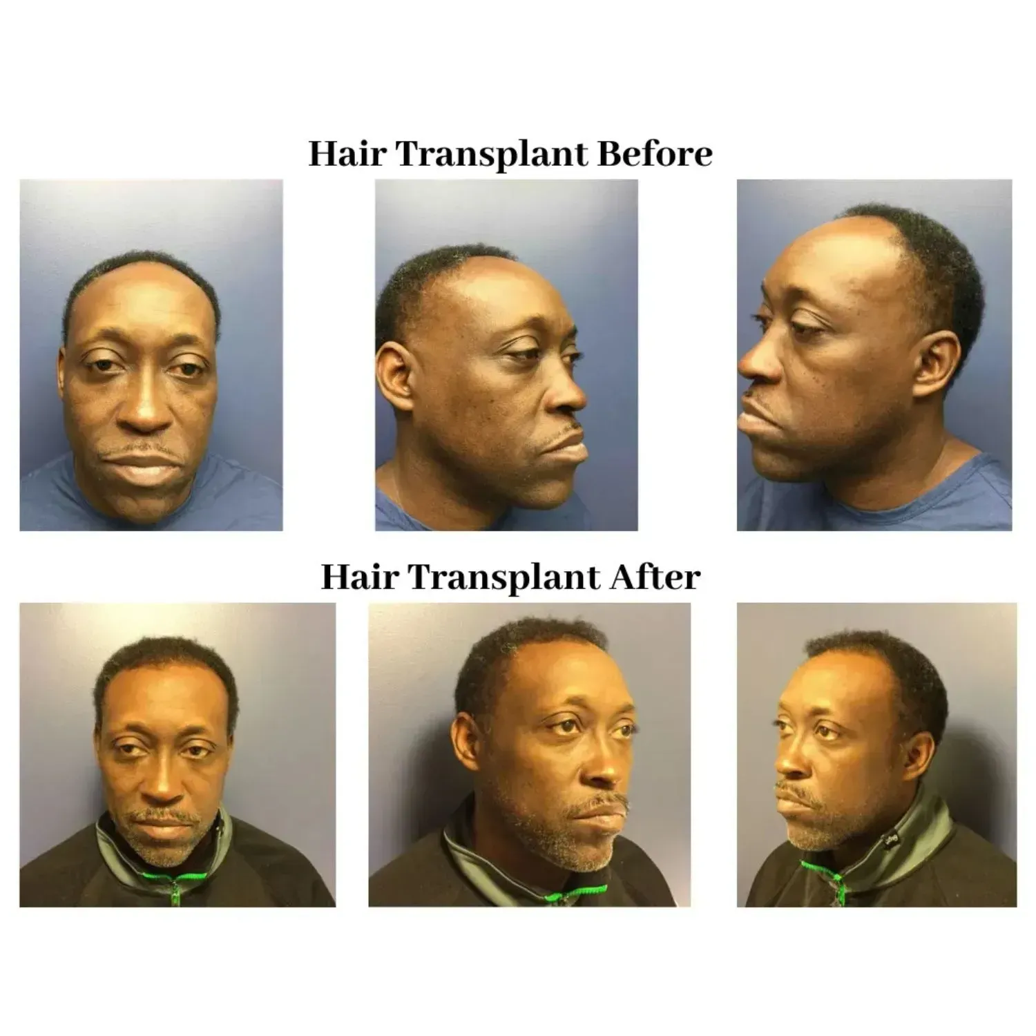 Hair transplant before and after