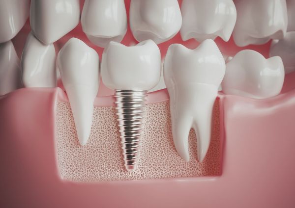 Implant tooth model