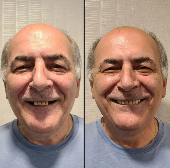 before and after full scope dental implant