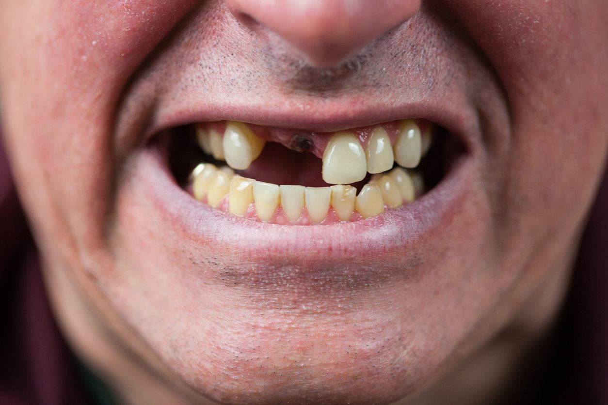 A man with missing teeth.