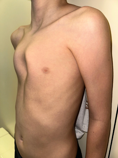 Pectus Carinatum