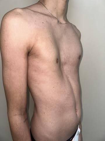 Pectus Excavatum