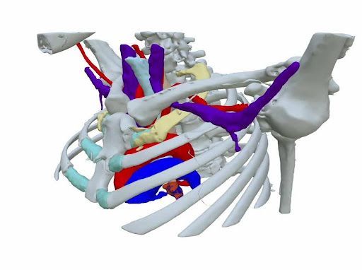 Síndrome do Desfiladeiro Torácico