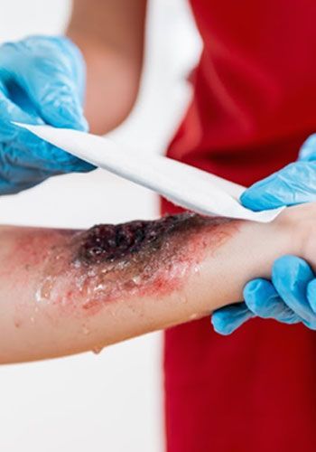 Medical professional in blue gloves treating a severe burn on a forearm, applying a white bandage.