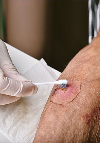 Gloved hand cleans a wound on arm with a cotton swab. The wound is outlined and red.