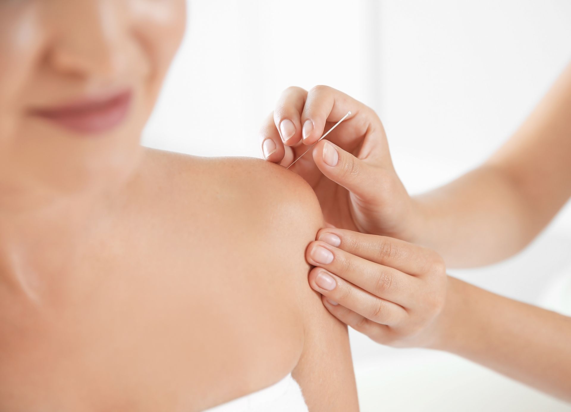 A woman is getting acupuncture on her shoulder.