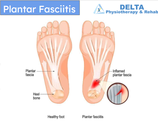 A diagram of a healthy foot and a foot with plantar fasciitis