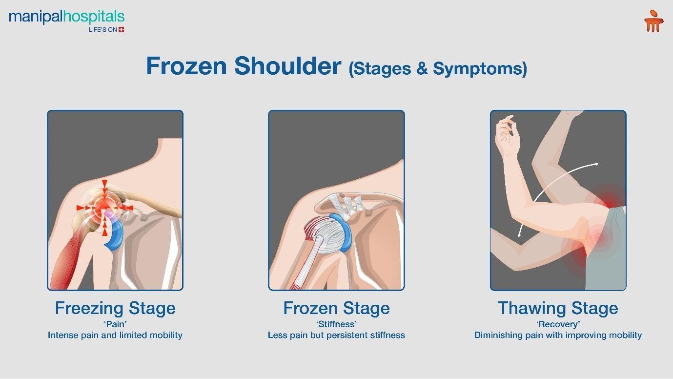 Three stages of frozen shoulder: freezing (pain), frozen (stiff), and thawing (recovering mobility).