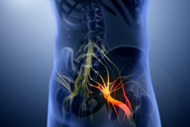 A poster for delta physiotherapy and rehab shows a person with sciatica