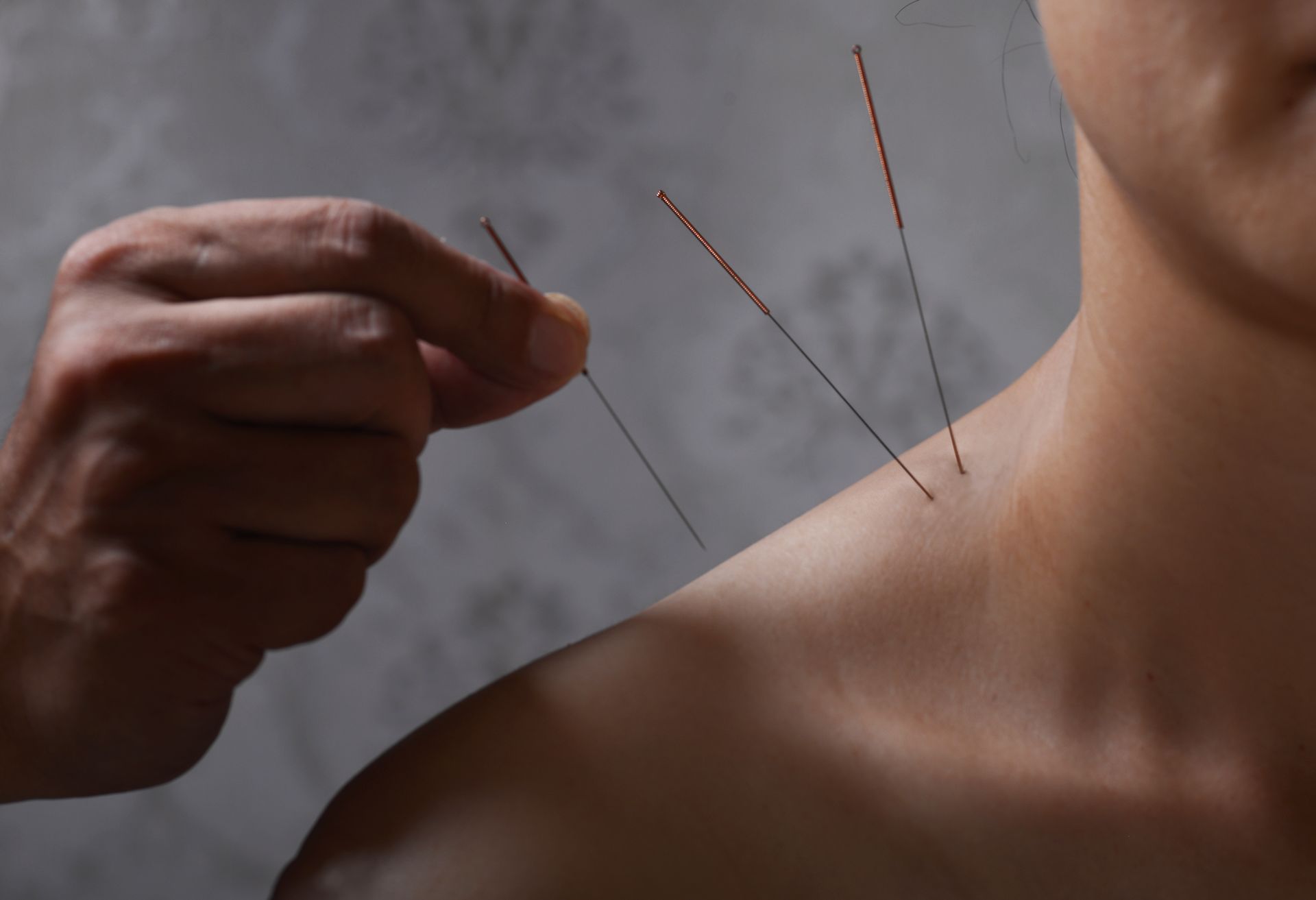 A person is getting acupuncture on their shoulder.
